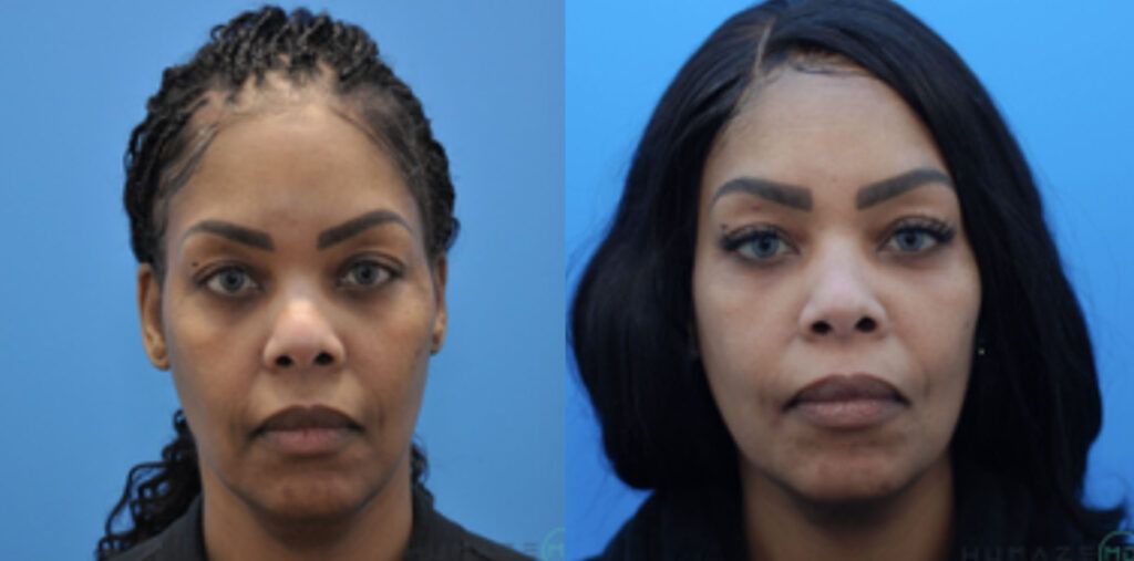 Chemical Peel and undereye filler