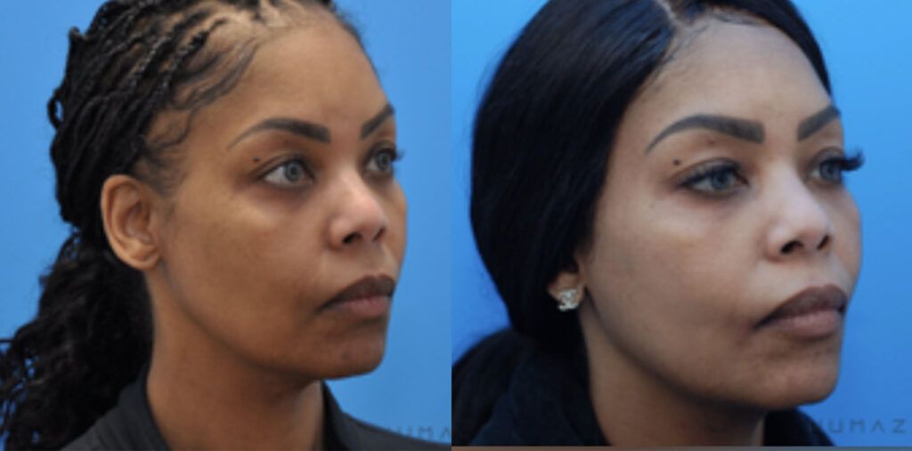 Chemical Peel and undereye filler