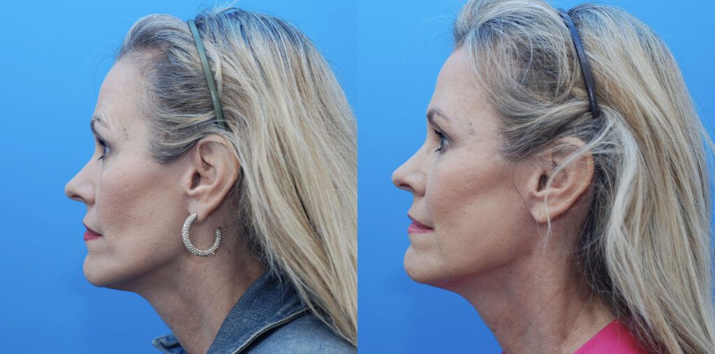 Facial Fat Grafting, chemical peel