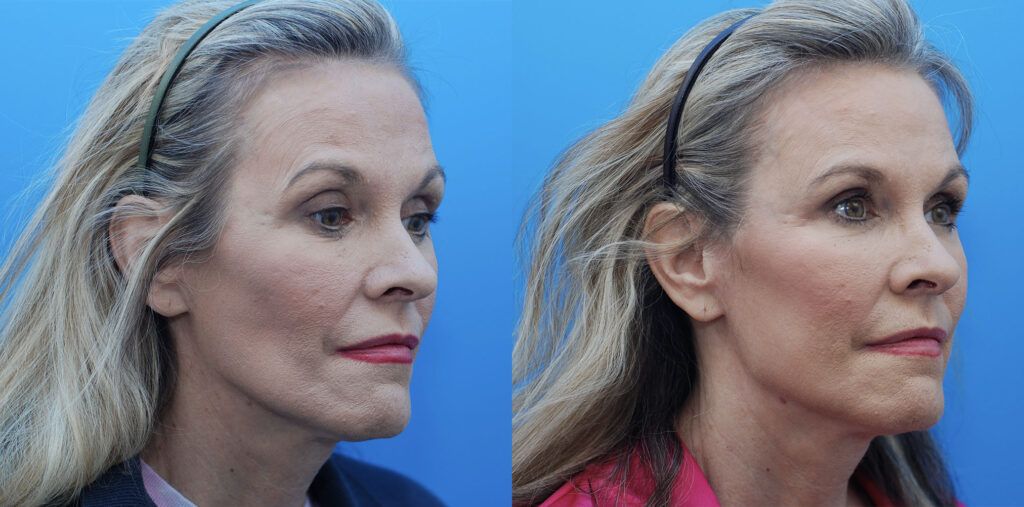 Facial Fat Grafting, chemical peel