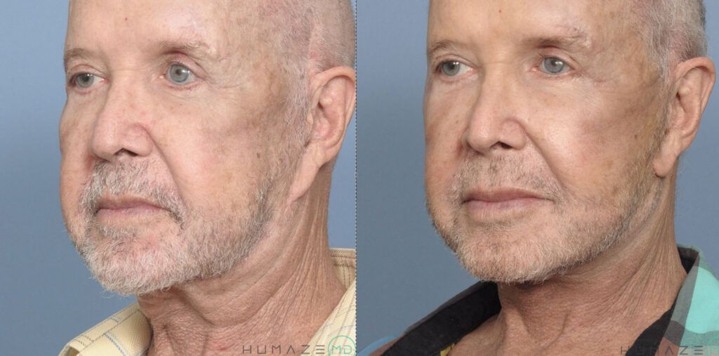 Revision Facelift, Necklift, canthopexy, ear lobe repair