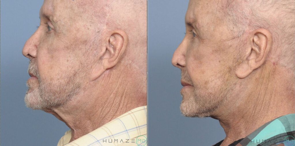 Revision Facelift, Necklift, canthopexy, ear lobe repair