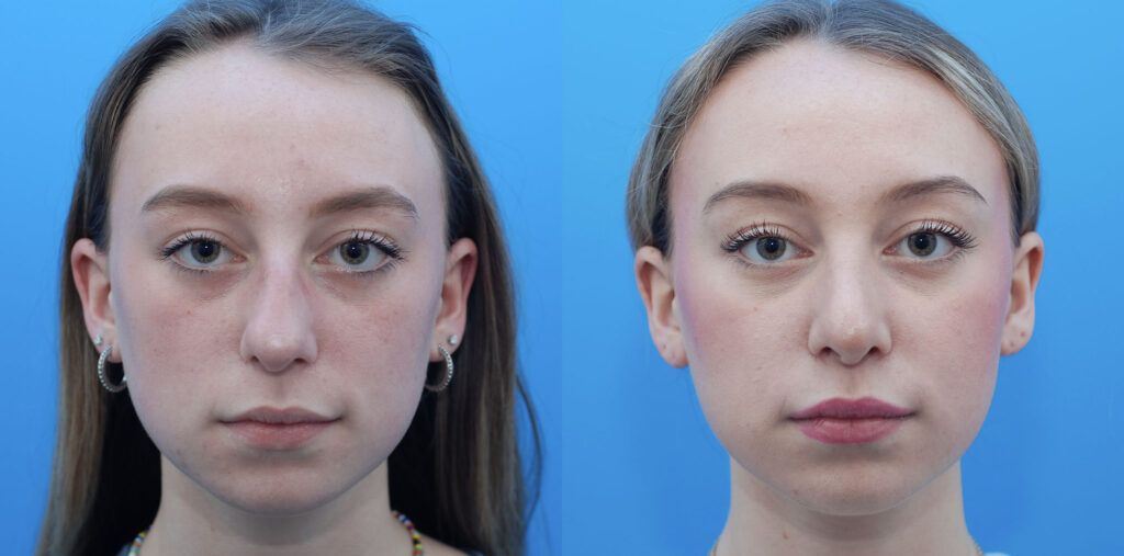 Rhinoplasty