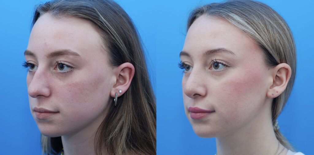 Rhinoplasty