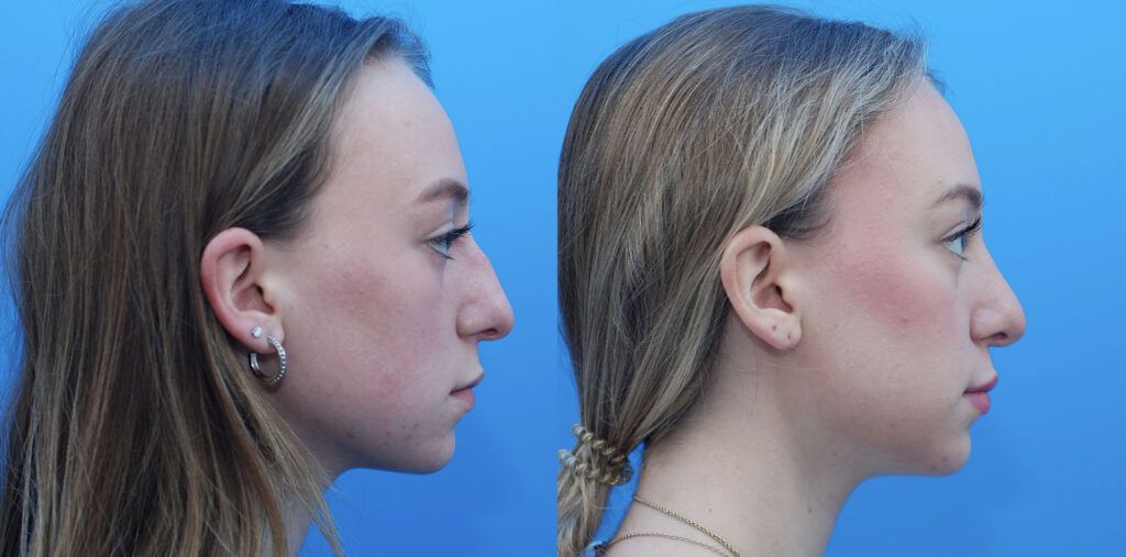 Rhinoplasty