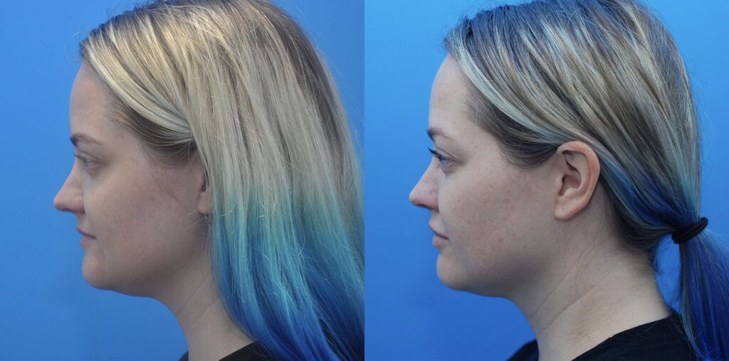 FaceTite, Liposuction