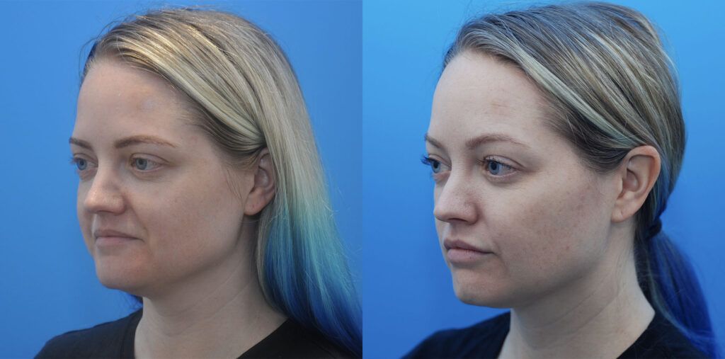 FaceTite, Liposuction