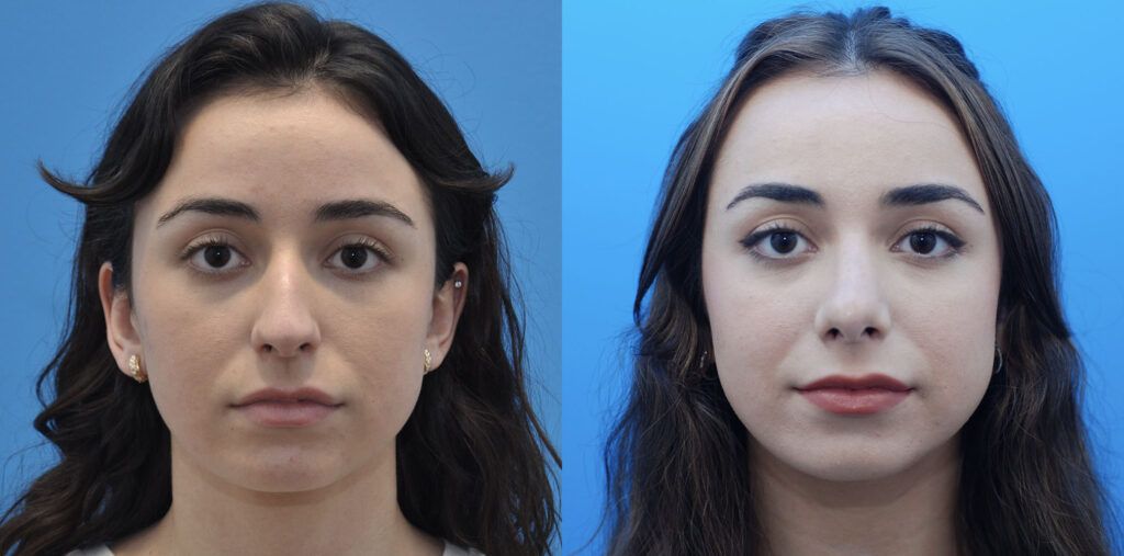 Rhinoplasty