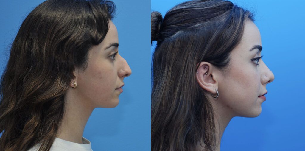 Rhinoplasty
