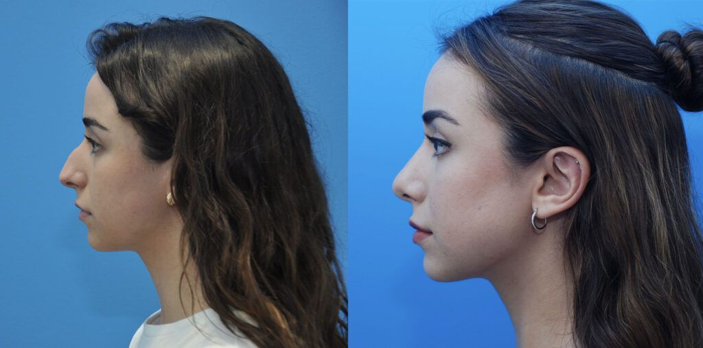 Rhinoplasty