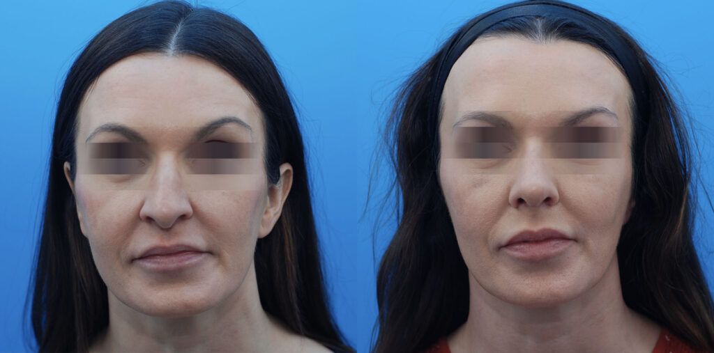 Rhinoplasty