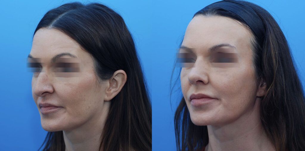 Rhinoplasty
