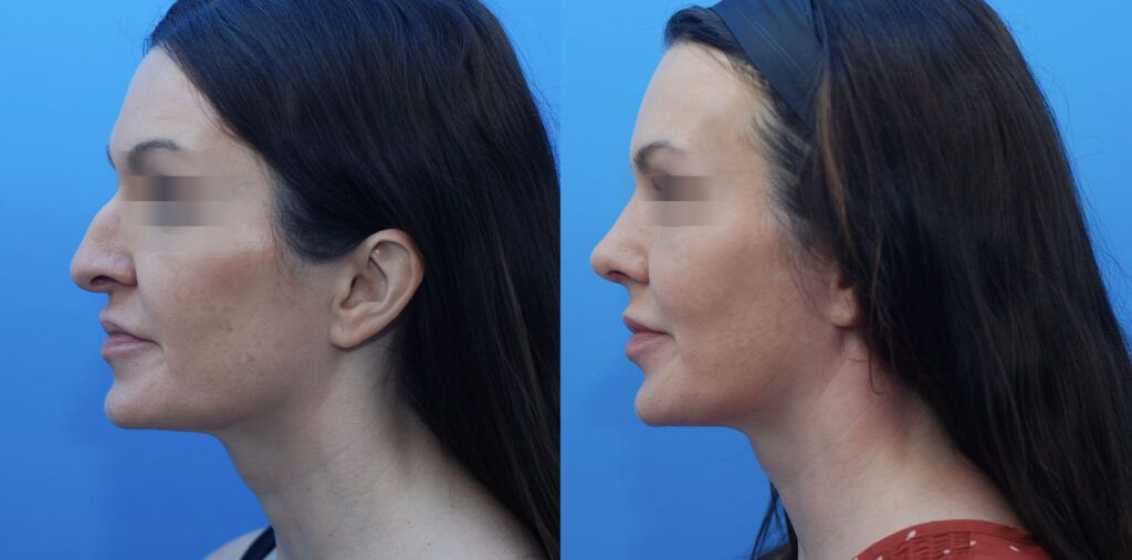 Rhinoplasty