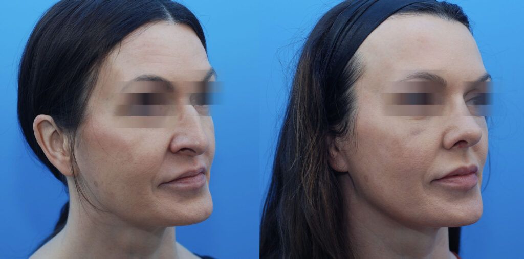 Rhinoplasty