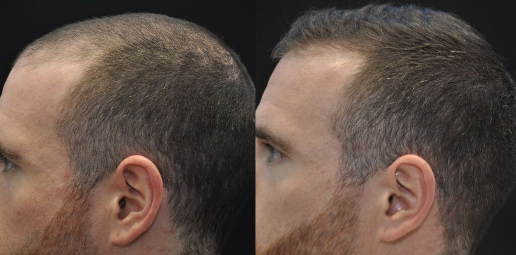 Hair restoration