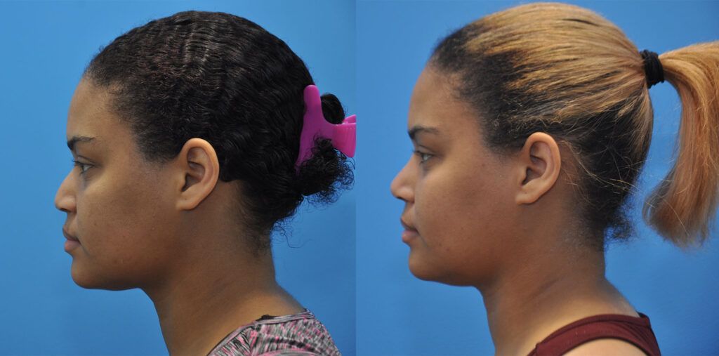 Rhinoplasty