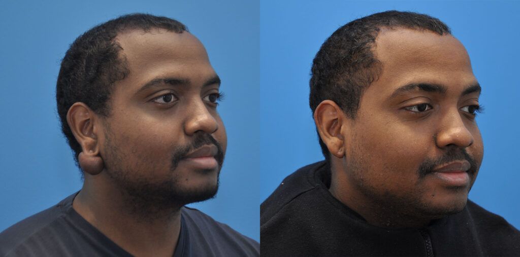 Scar Revision, otoplasty