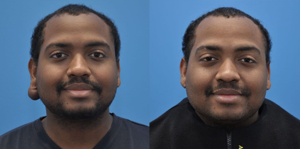 Scar Revision, otoplasty