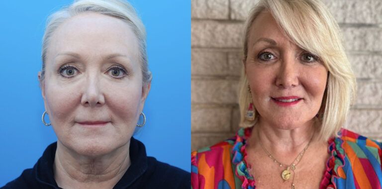 Browlift, upper bleph, lower bleph, facial fat grafting, facelift, necklift, lip lift, CO2 laser