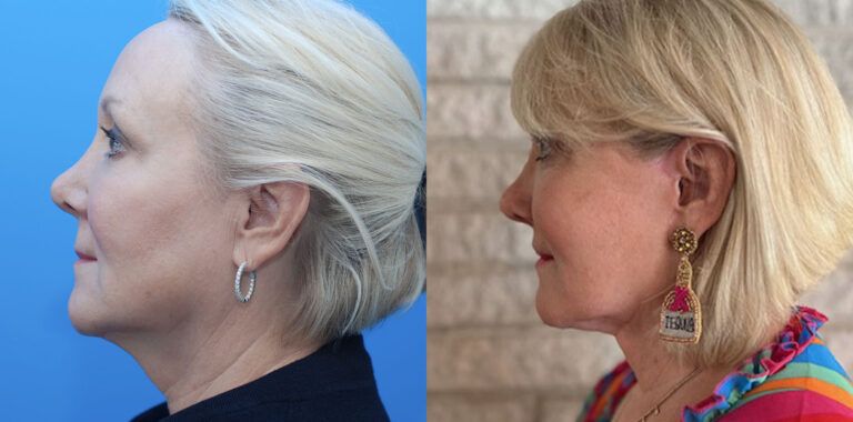 Browlift, upper bleph, lower bleph, facial fat grafting, facelift, necklift, lip lift, CO2 laser