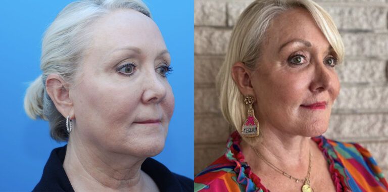 Browlift, upper bleph, lower bleph, facial fat grafting, facelift, necklift, lip lift, CO2 laser