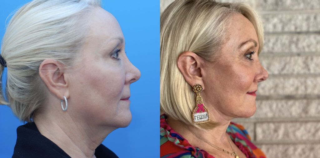 Browlift, upper bleph, lower bleph, facial fat grafting, facelift, necklift, lip lift, CO2 laser