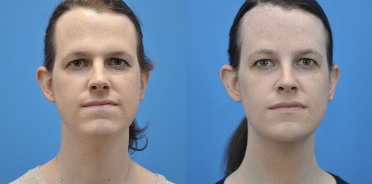 FFS, brow bone reduction, forehead reduction, brow lift, upper bleph, rhinoplasty, chin reduction