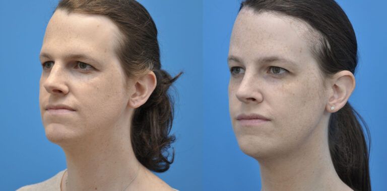 FFS, brow bone reduction, forehead reduction, brow lift, upper bleph, rhinoplasty, chin reduction