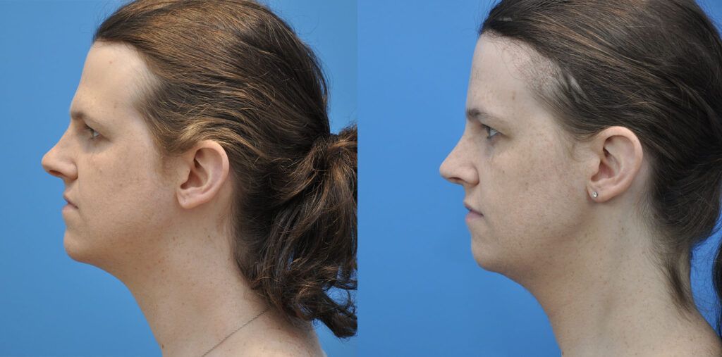 FFS, brow bone reduction, forehead reduction, brow lift, upper bleph, rhinoplasty, chin reduction