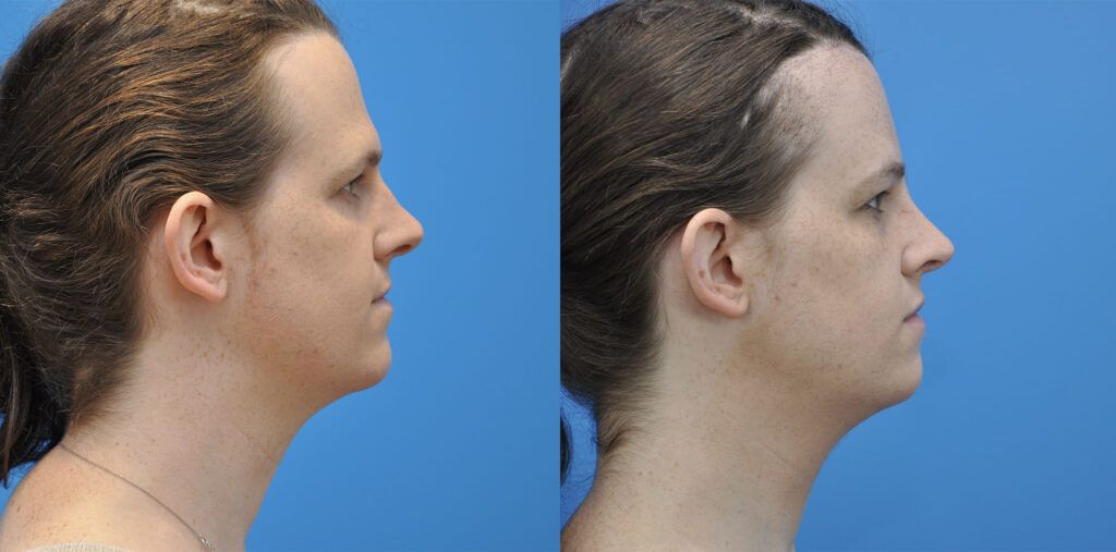 FFS, brow bone reduction, forehead reduction, brow lift, upper bleph, rhinoplasty, chin reduction
