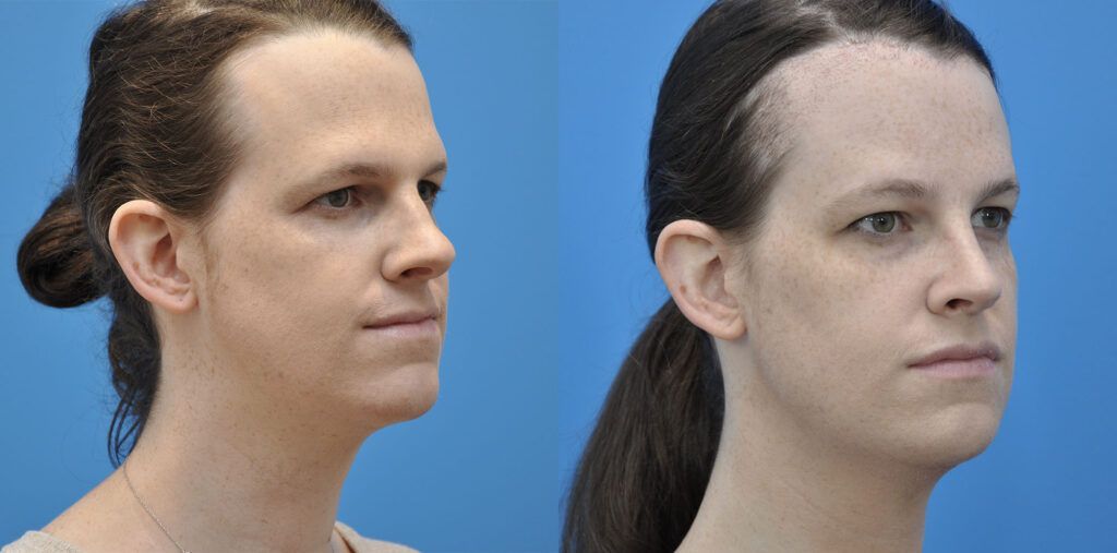 FFS, brow bone reduction, forehead reduction, brow lift, upper bleph, rhinoplasty, chin reduction