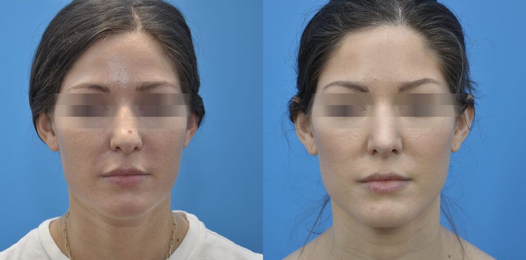 Rhinoplasty with mole removal