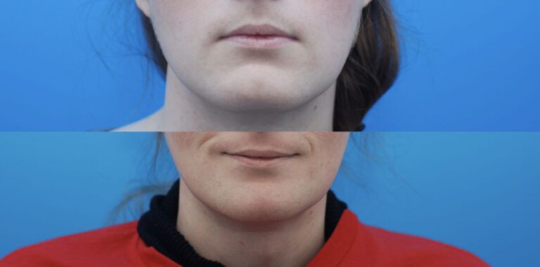 Facial Feminization (FFS), Jaw Contouring, Genioplasty