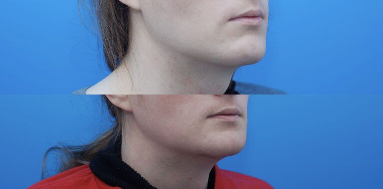 Facial Feminization (FFS), Jaw Contouring, Genioplasty