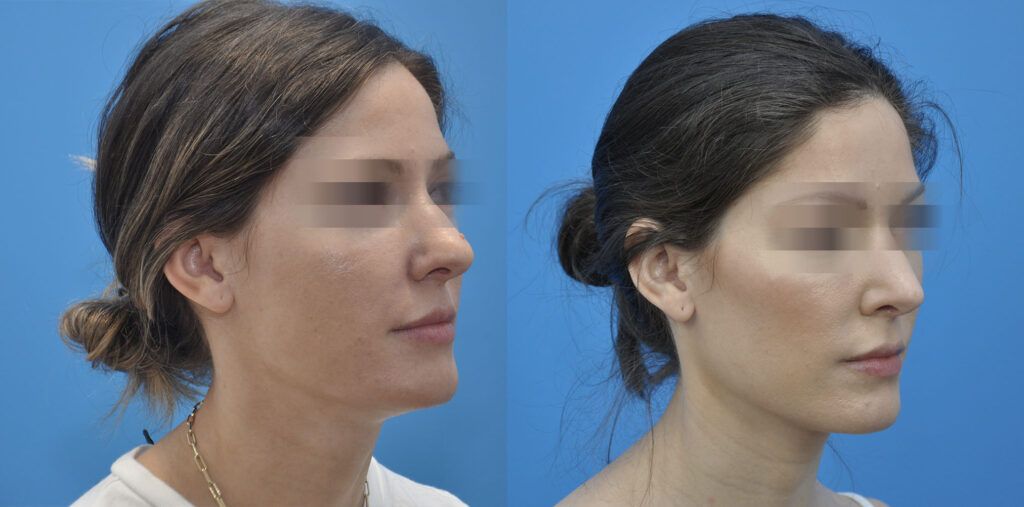 Rhinoplasty with mole removal