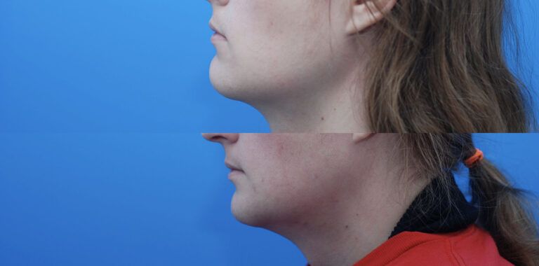 Facial Feminization (FFS), Jaw Contouring, Genioplasty