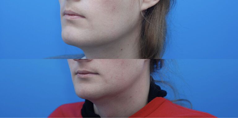 Facial Feminization (FFS), Jaw Contouring, Genioplasty