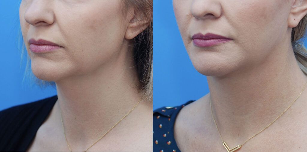 Upper bleph, lower bleph with fat grafting, chin implant, facelift, necklift