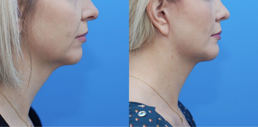 Upper bleph, lower bleph with fat grafting, chin implant, facelift, necklift