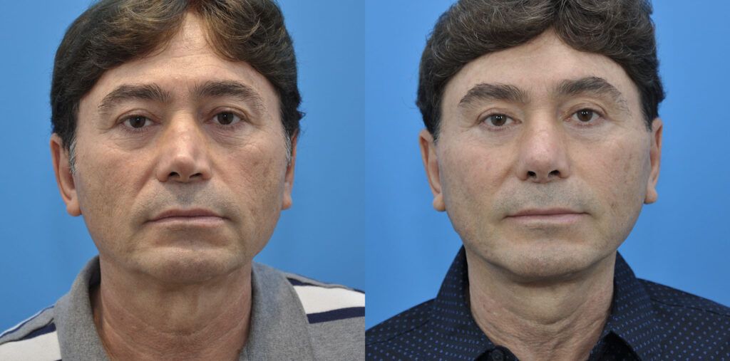 Facelift, necklift, browlift, upper blepharoplasty, revision rhinoplasty