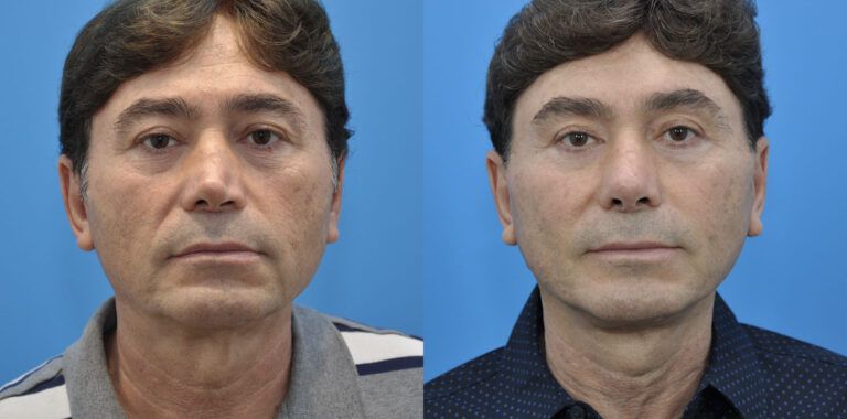 Facelift, necklift, browlift, upper blepharoplasty, revision rhinoplasty
