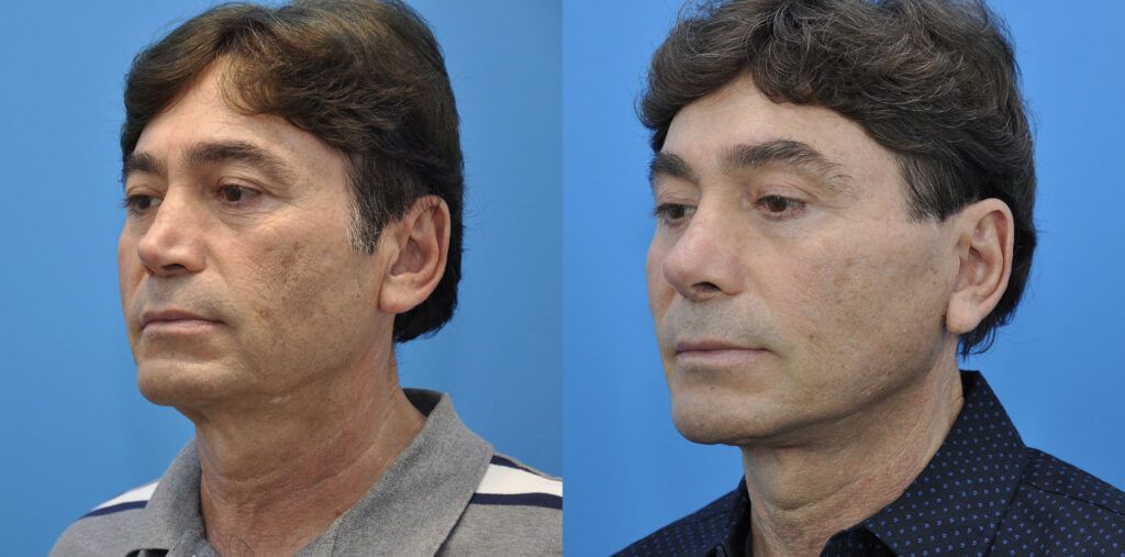 Facelift, necklift, browlift, upper blepharoplasty, revision rhinoplasty