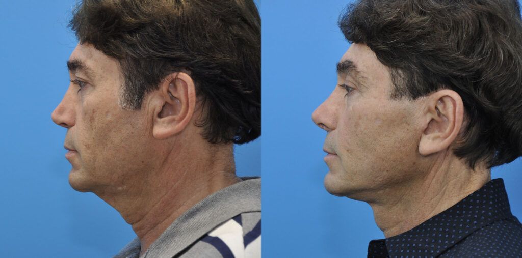 Facelift, necklift, browlift, upper blepharoplasty, revision rhinoplasty