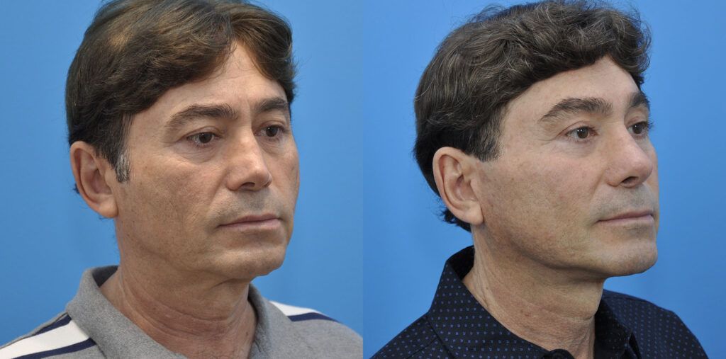 Facelift, necklift, browlift, upper blepharoplasty, revision rhinoplasty