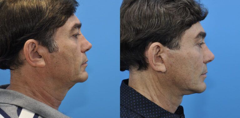Facelift, necklift, browlift, upper blepharoplasty, revision rhinoplasty