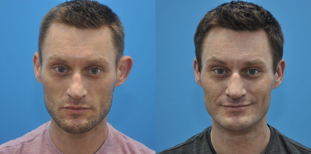 Otoplasty, facial fat grafting, rhinoplasty