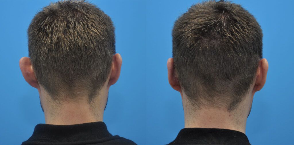 Otoplasty, facial fat grafting, rhinoplasty