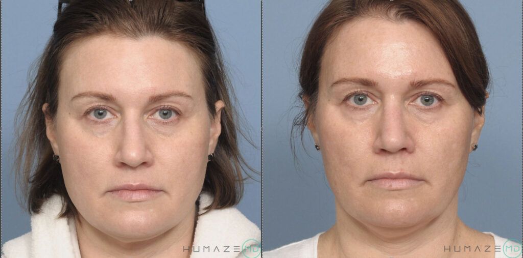 Rhinoplasty and septoplasty