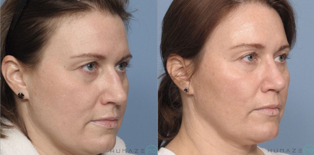 Rhinoplasty and septoplasty