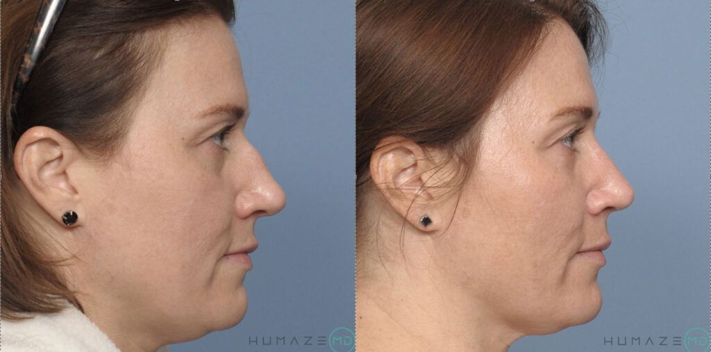 Rhinoplasty and septoplasty
